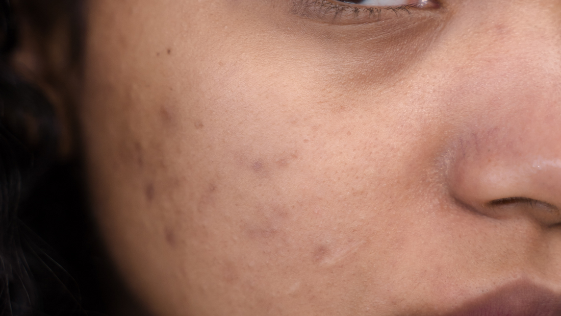 microneedling rejuran polyneuceotides hyperpigmentation peels