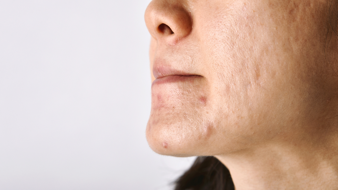 rejuran acne scarring microneedling